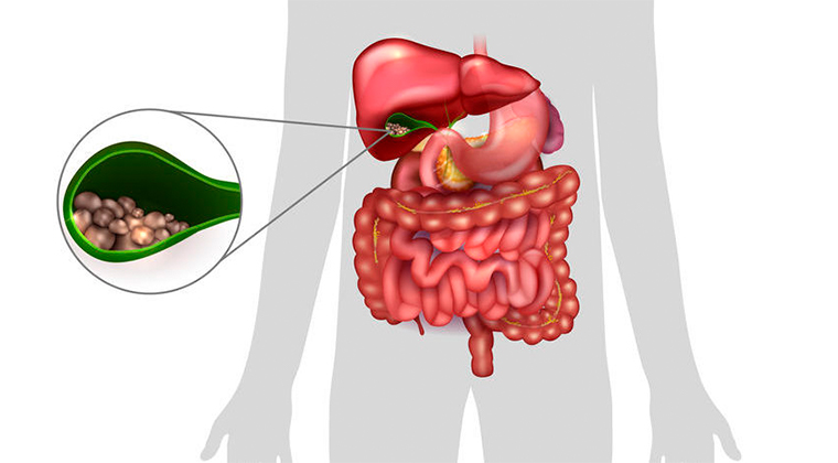 Colelitiasis (Piedras en la vesícula biliar)