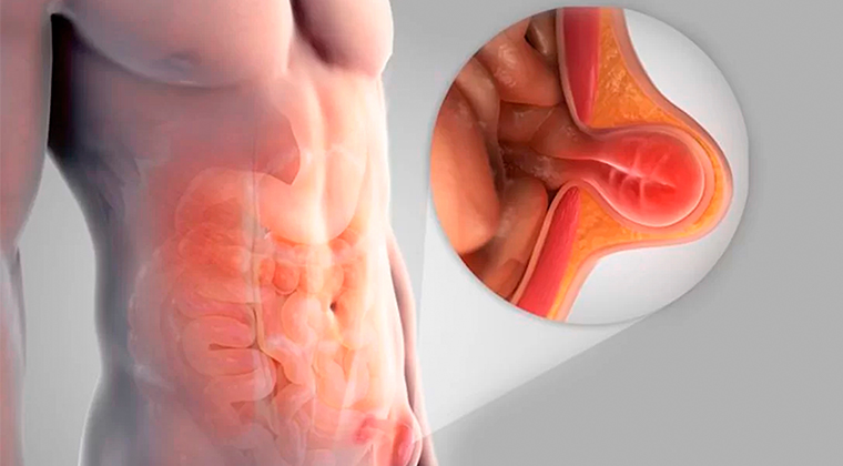 Hernias (Inguinal, umbilical, hiatal)