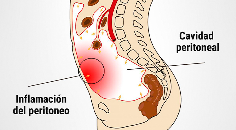 Peritonitis